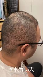 -雍禾植发全国连锁