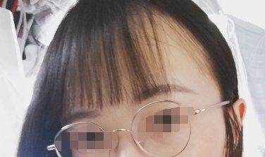 -大麦微针植发丨全国连锁