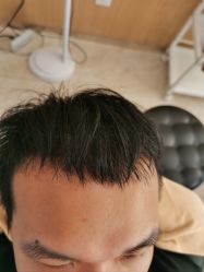 -大麦微针植发丨全国连锁