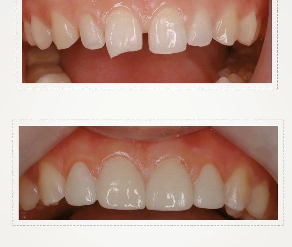 前牙美学修复 #牙冠修复 #瑞泰口腔