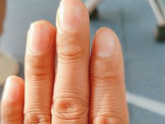 -新甲连锁灰指甲·甲沟炎·修脚(爱联店)