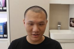 点击看大图 -大麦微针植发丨全国连锁