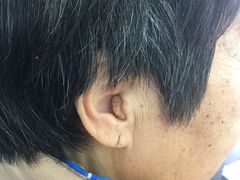 宝山定制式助听器隐形款-宁耳听力助听器奥迪康·峰力·西门子(宝山店)