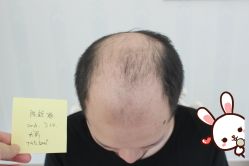 -大麦微针植发丨全国连锁