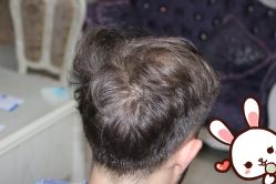 点击看大图 -大麦微针植发丨全国连锁