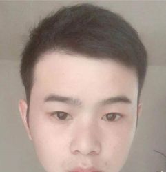 -碧莲盛·不剃发植发