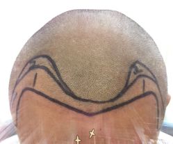 -大麦微针植发全国连锁