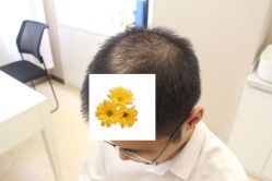-大麦微针植发丨全国连锁