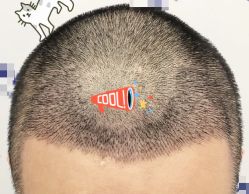 -大麦微针植发全国连锁