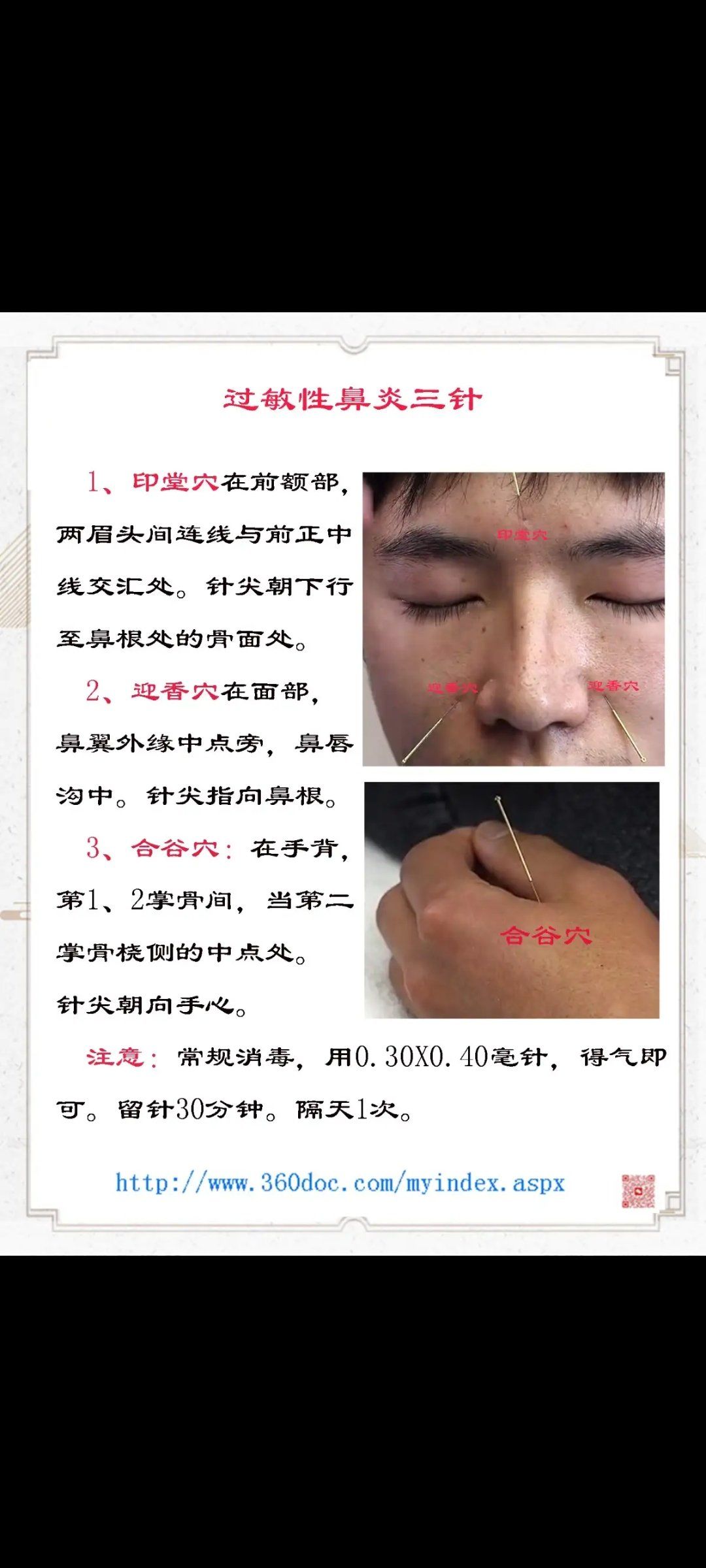 过敏性鼻炎的针灸艾灸治疗