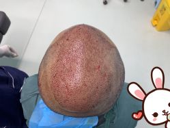 点击看大图 -大麦微针植发丨全国连锁