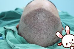 -大麦微针植发丨全国连锁