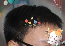 -大麦微针植发全国连锁