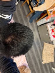 -大麦微针植发丨全国连锁