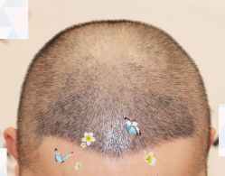 -大麦微针植发全国连锁