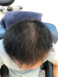 -大麦微针植发全国连锁