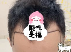 -大麦微针植发全国连锁