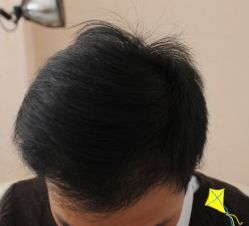 -大麦微针植发丨全国连锁