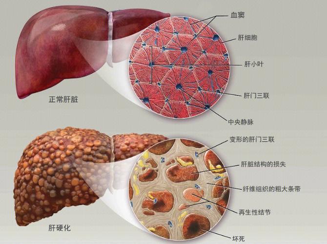 肝脏假小叶图片