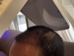 -碧莲盛·不剃发植发