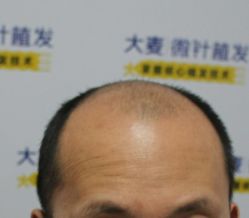 -大麦微针植发丨全国连锁