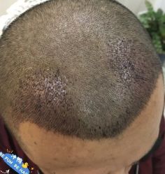 -大麦微针植发丨全国连锁