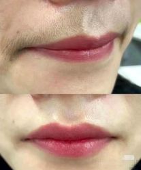 -薇兰专业脱毛连锁机构