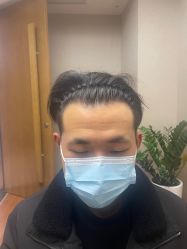 体验后-大麦微针植发全国连锁