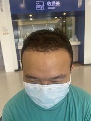 体验后-大麦微针植发全国连锁