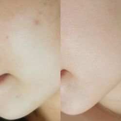 体验前-郑荃丽格医疗美容