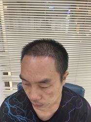 -大麦微针植发丨全国连锁