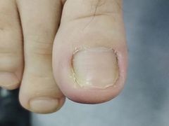 -祖传修脚甲沟炎灰指甲鸡眼