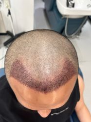 -大麦微针植发全国连锁