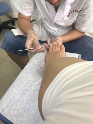 点击看大图 -德哥灰指甲脚气甲沟炎跖疣护理