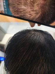 -碧莲盛·不剃发植发