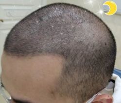 -大麦微针植发丨全国连锁