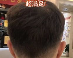 -大麦微针植发全国连锁