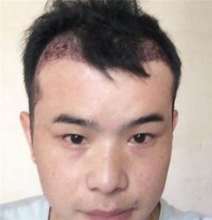 -碧莲盛·不剃发植发