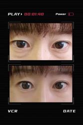 体验前-紫洁俪方（北京）医疗美容