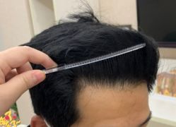 -大麦微针植发丨全国连锁
