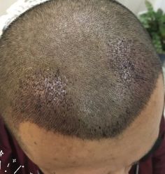 -大麦微针植发丨全国连锁