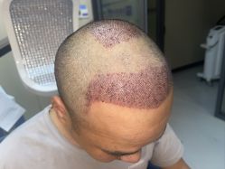 体验后-大麦微针植发全国连锁