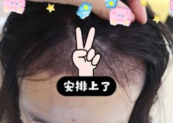 -大麦微针植发全国连锁