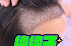 -大麦微针植发丨全国连锁