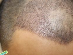 -大麦微针植发丨全国连锁