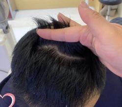 -大麦微针植发丨全国连锁