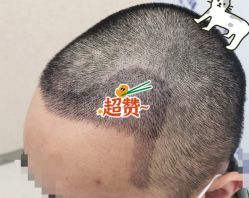 -大麦微针植发全国连锁