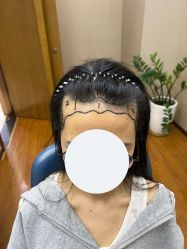 -大麦微针植发全国连锁