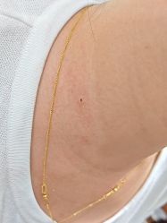 -痣斑堂·取大痣