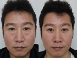 -广州健丽·去眼袋医疗美容机构